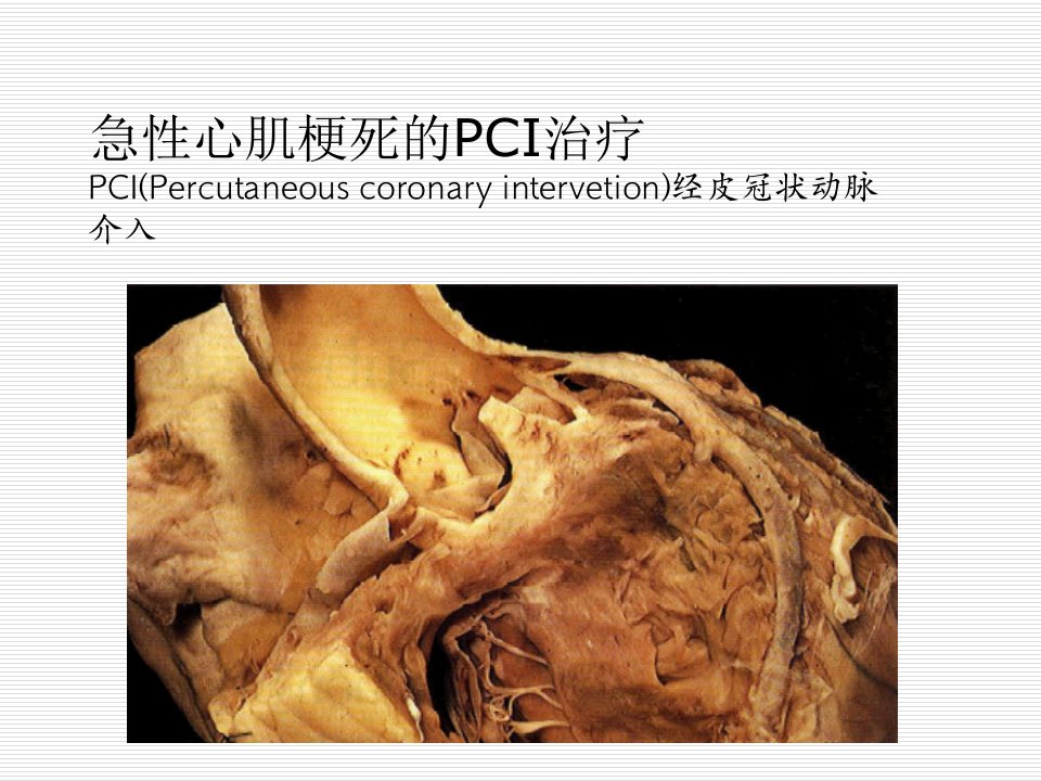 急性心肌梗死的PCI治疗