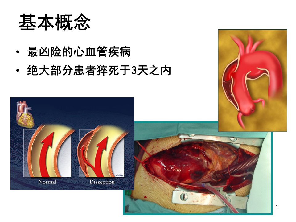 A型主动脉夹层的围术期管理PPT课件