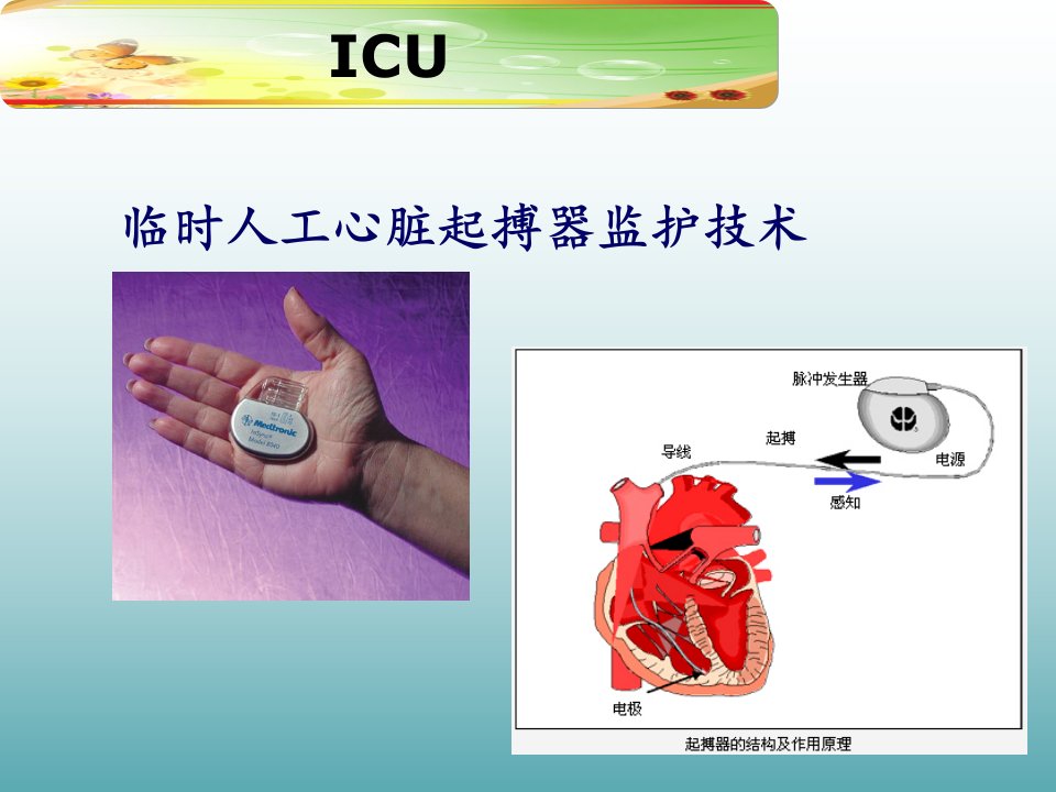 课件临时人工心脏起搏器监护技术