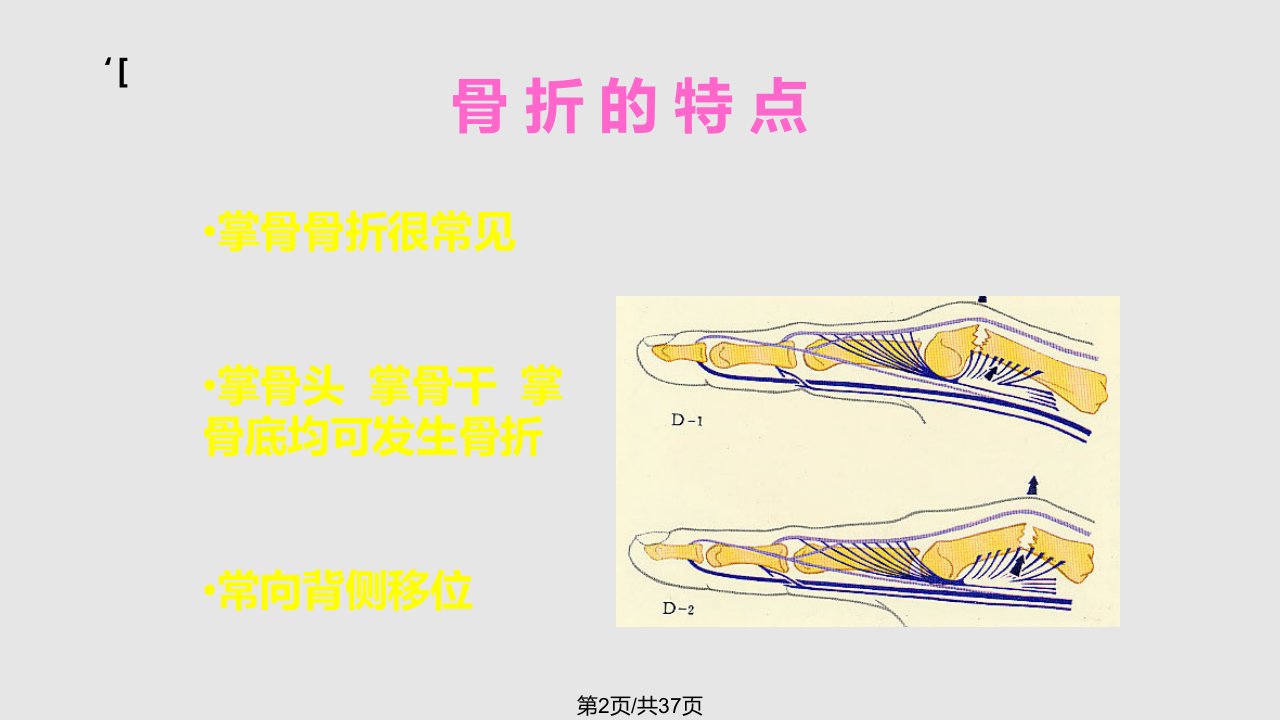 掌骨骨折学习