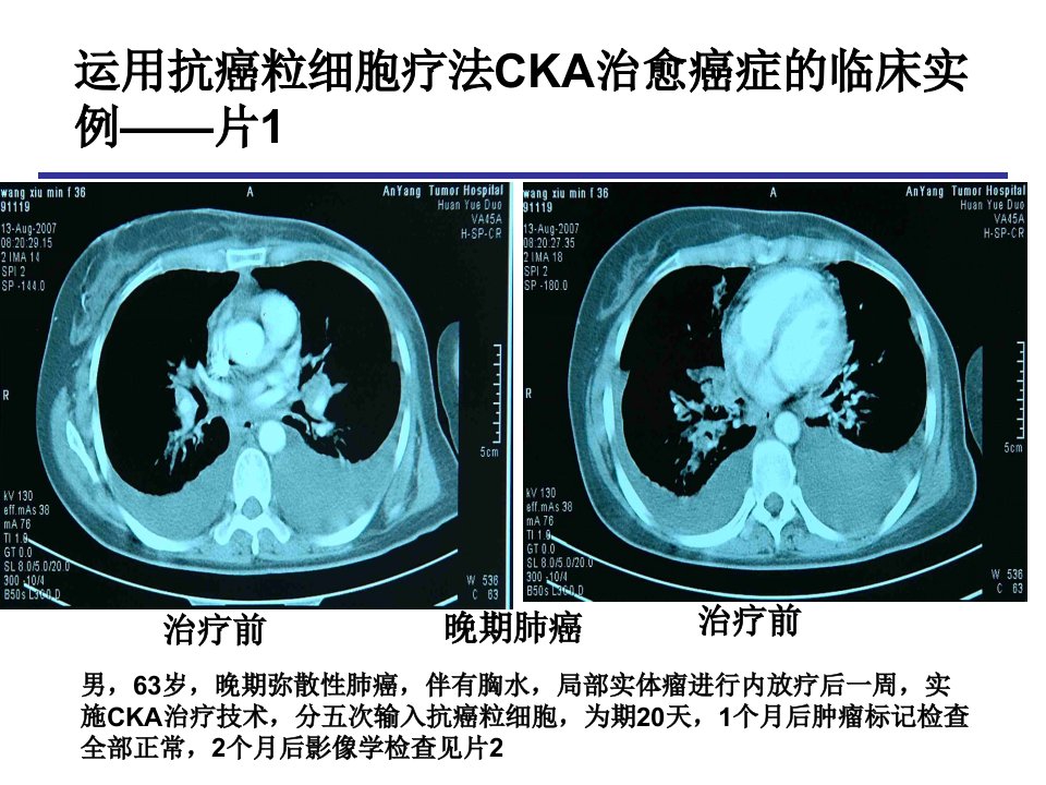 运用抗癌粒细胞疗法CKA治愈癌症的临床实例