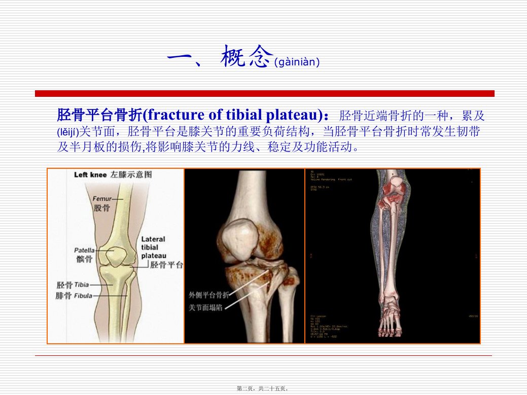 医学专题胫骨平台骨折