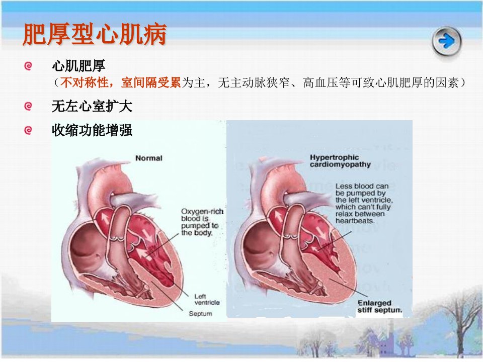 《肥厚型心肌病》PPT课件