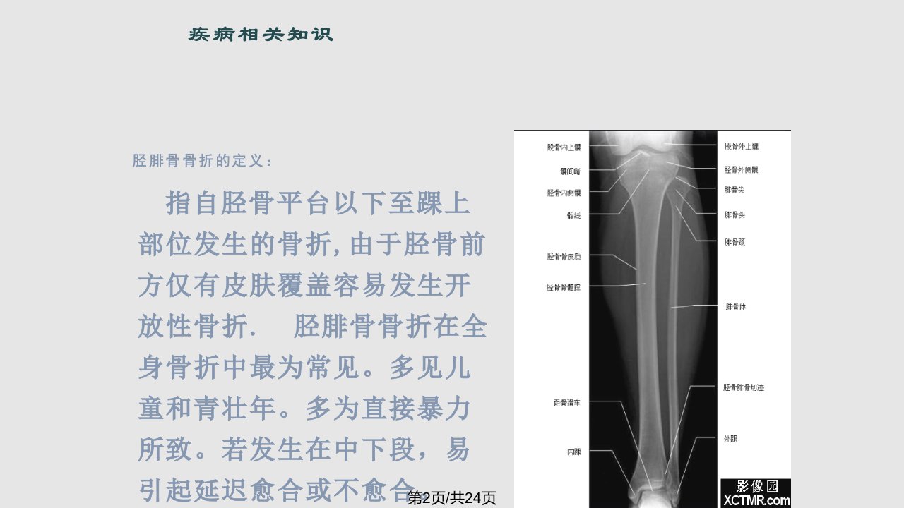 胫腓骨骨折的护理查房