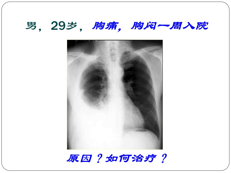 【学习课件】第十一章胸腔积液