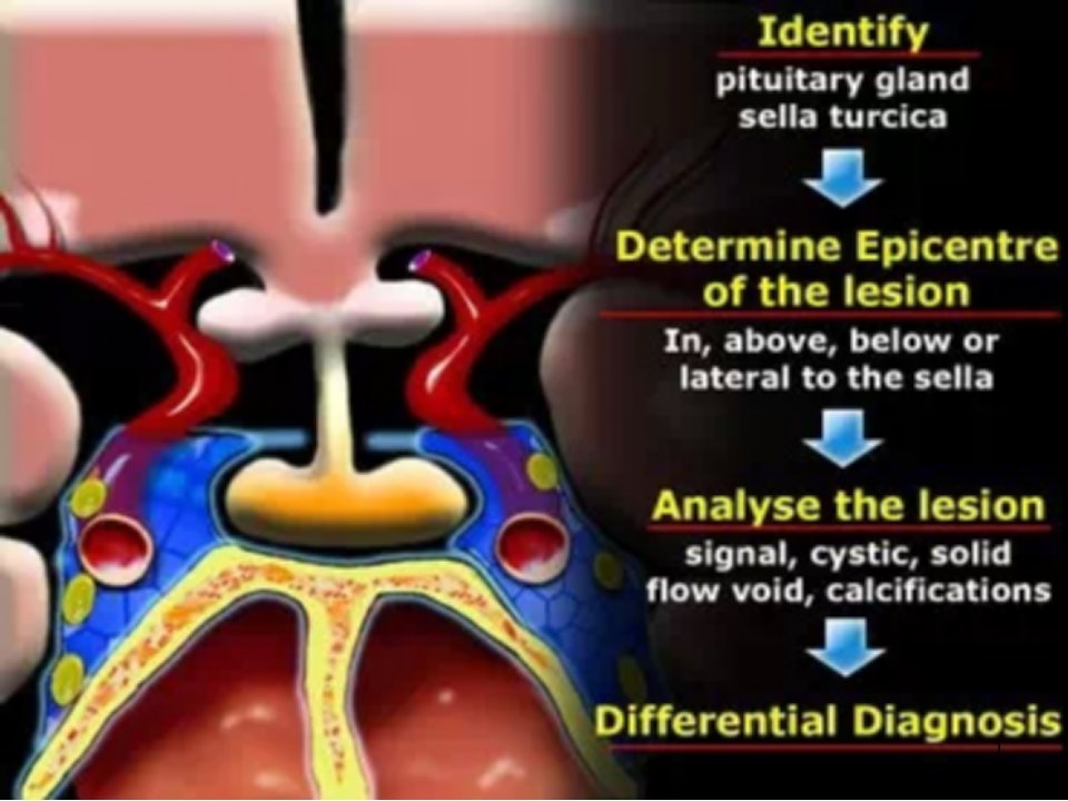 蝶鞍区域病变影像诊断与分析策略ppt课件