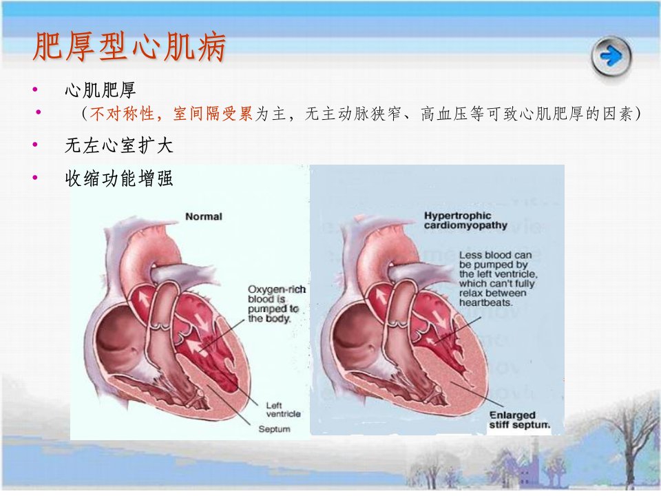 《肥厚型心肌病》PPT课件