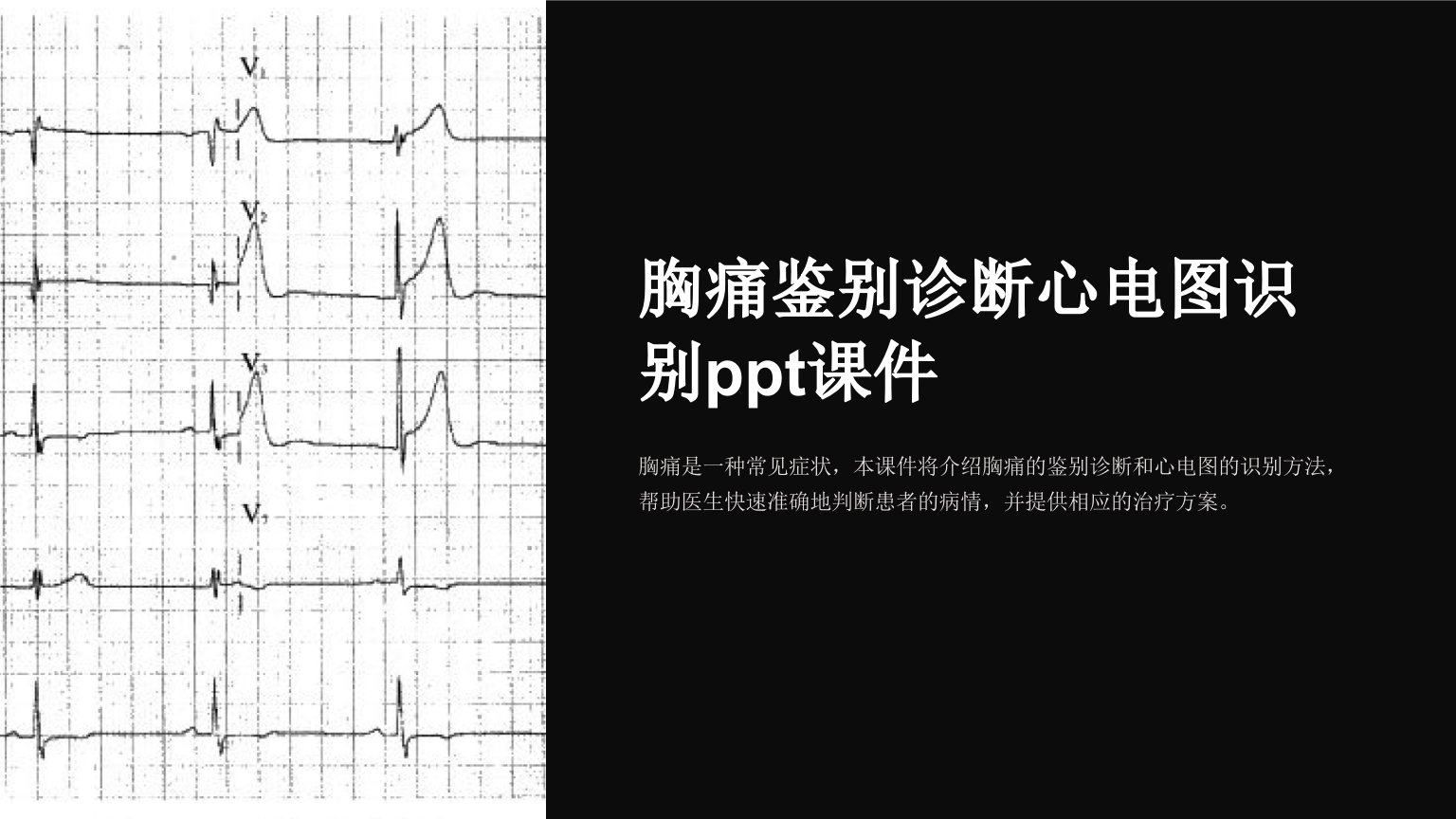 胸痛鉴别诊断心电图识别课件