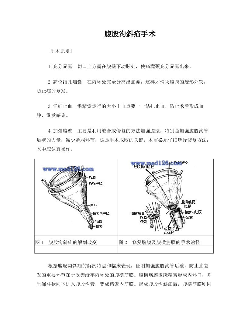 腹股沟斜疝手术