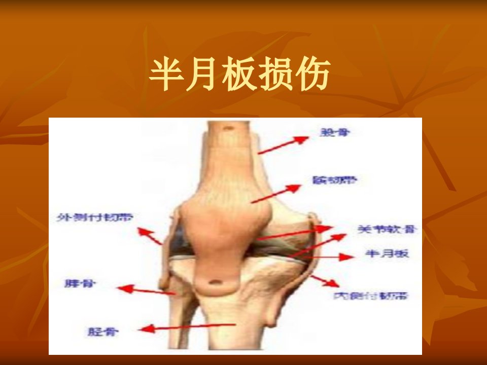 半月板损伤影像表现