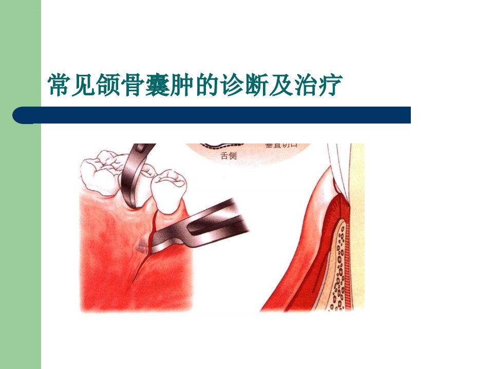 颌骨囊肿图文ppt课件