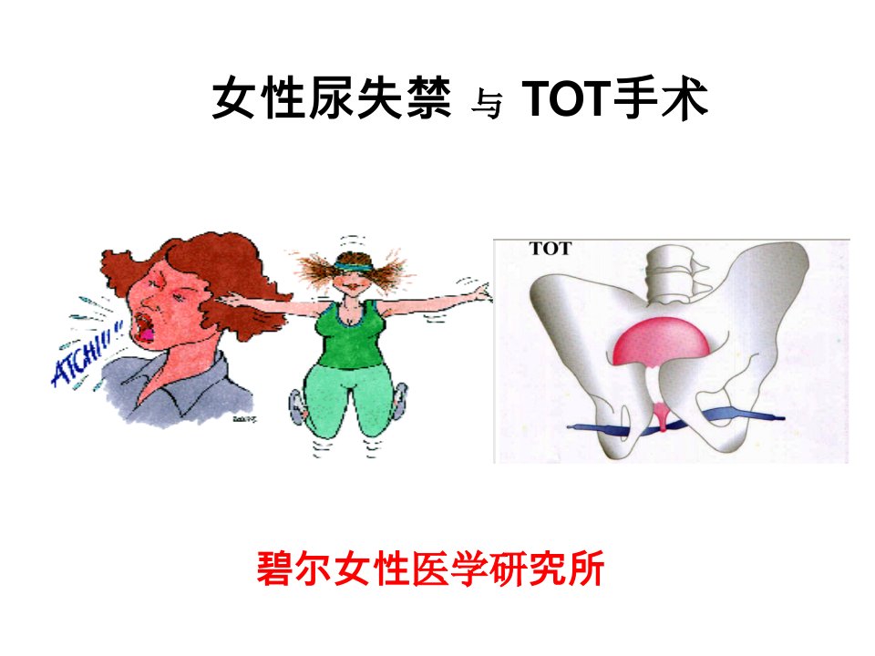 压力性尿失禁TOT治疗