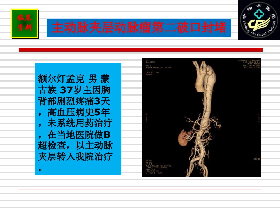 主动脉夹层动脉瘤第二破口封堵我们的经验与思考课件