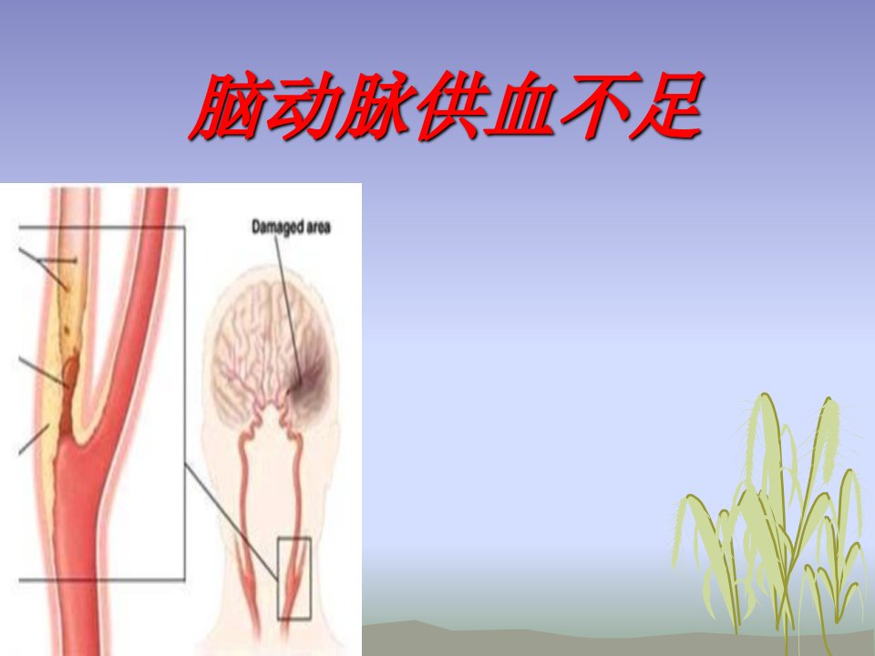 脑动脉供血不足