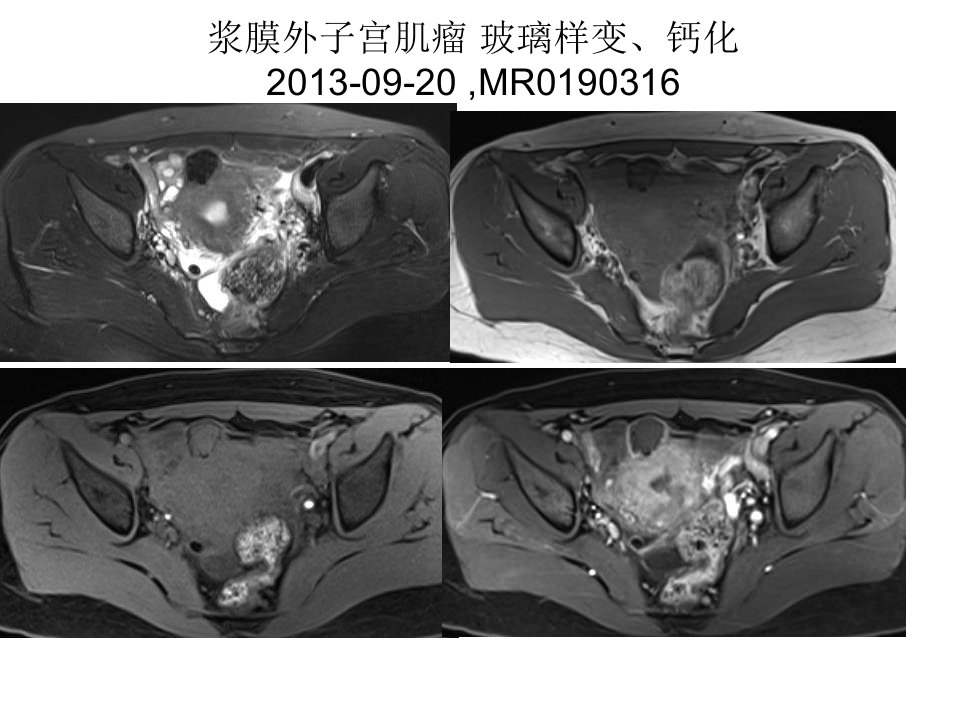 《女性盆腔疾病mr读》PPT课件