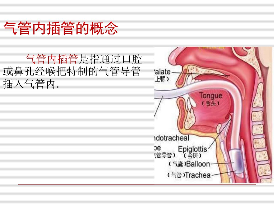 2021年气管插管术医学宣教