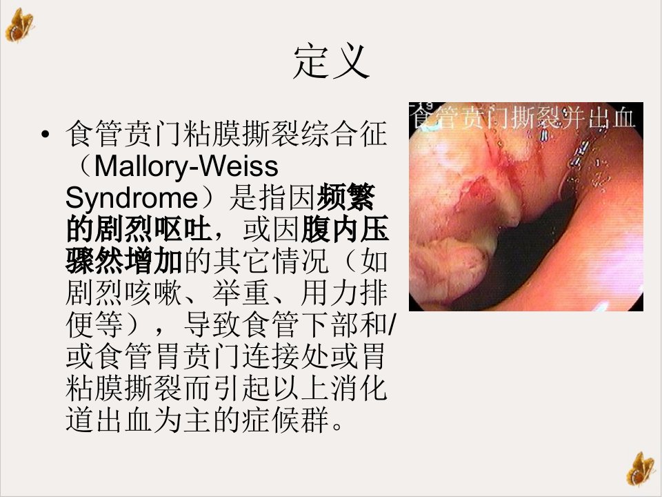 食管贲门粘膜撕裂综合征