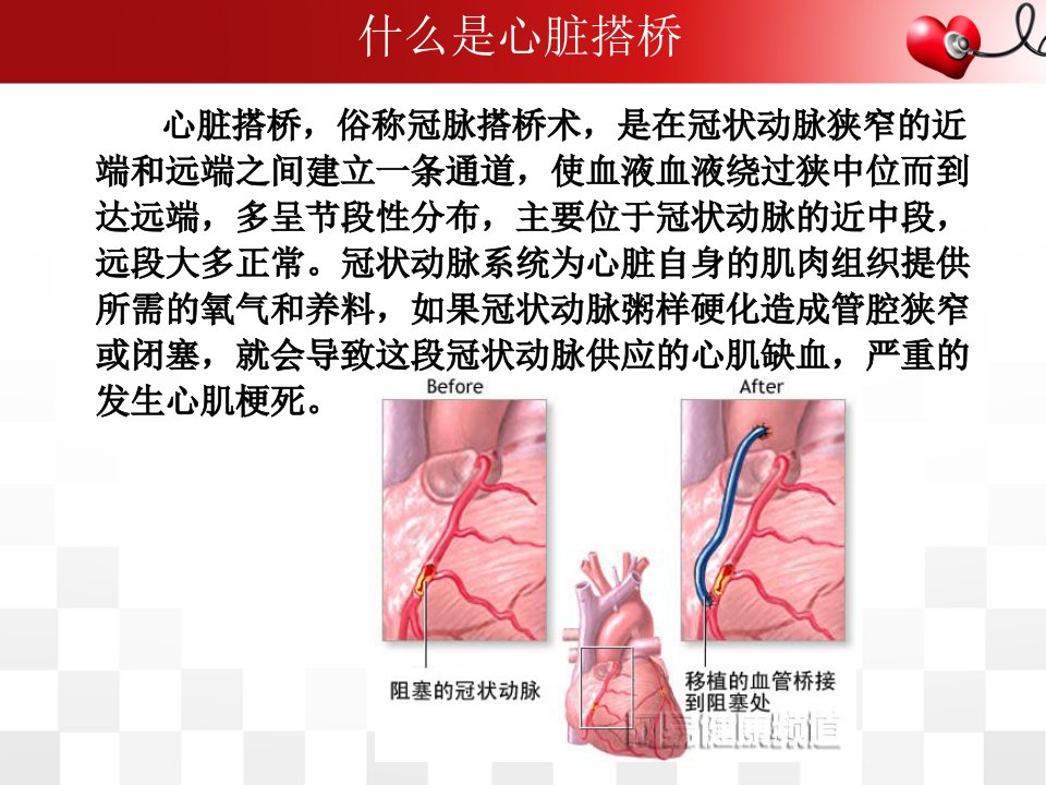 冠脉搭桥术后护理查房课件