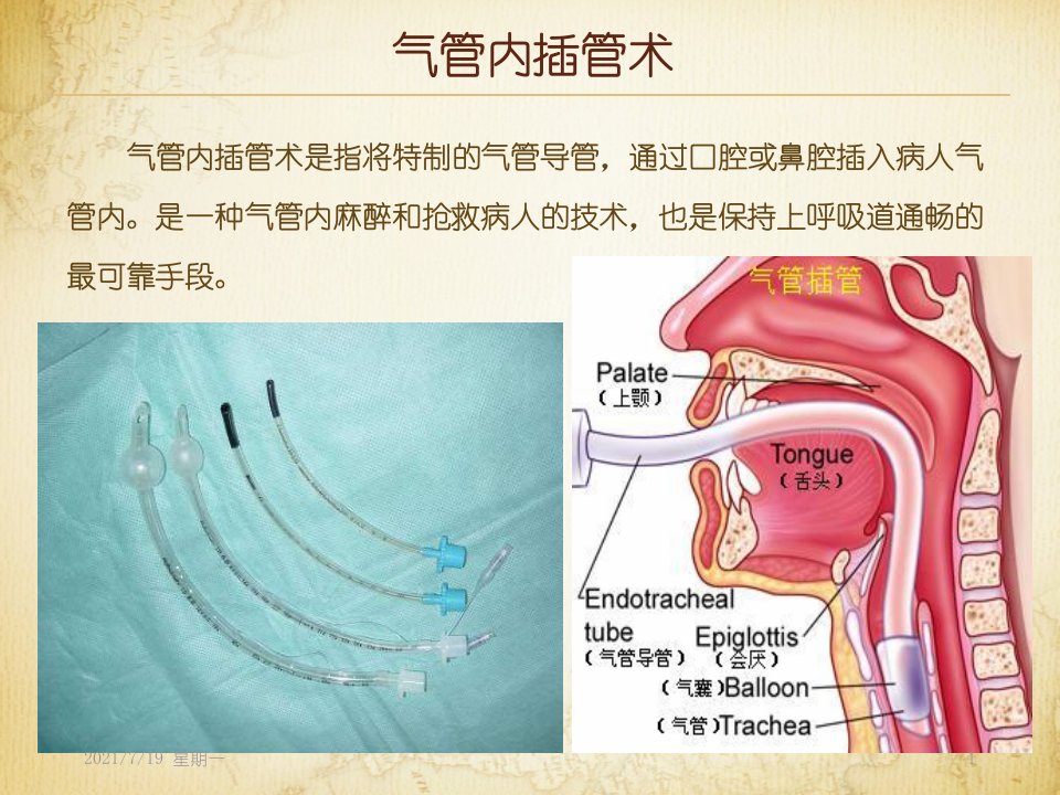 医学专题气管内插管术与气管切开术