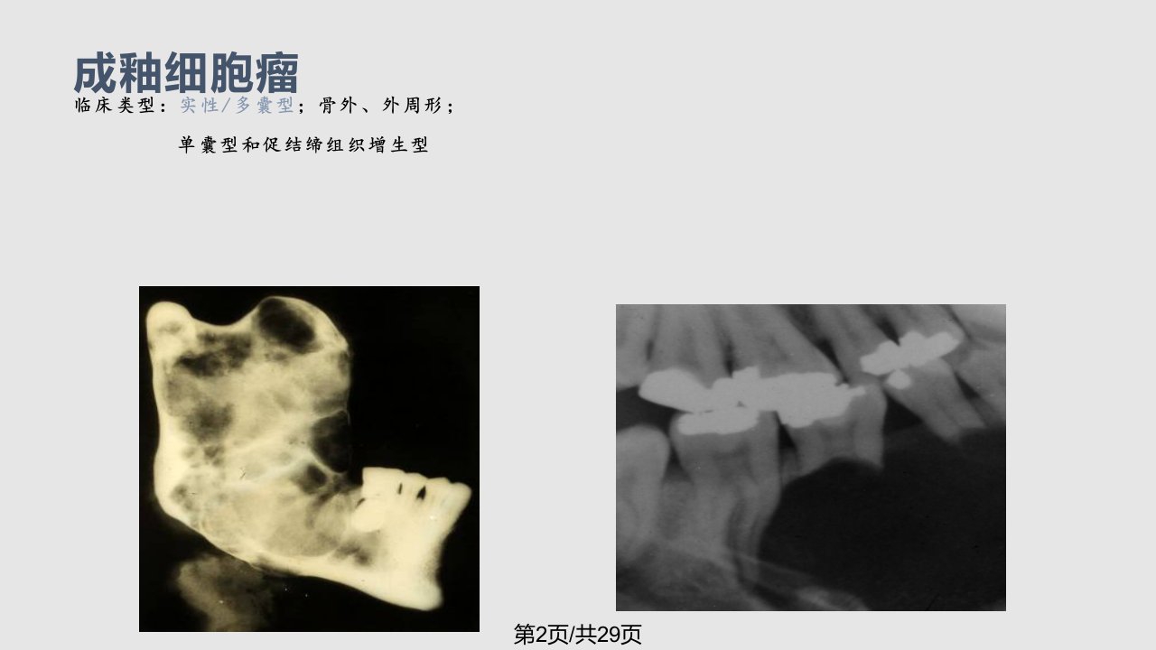 牙源性肿瘤学习