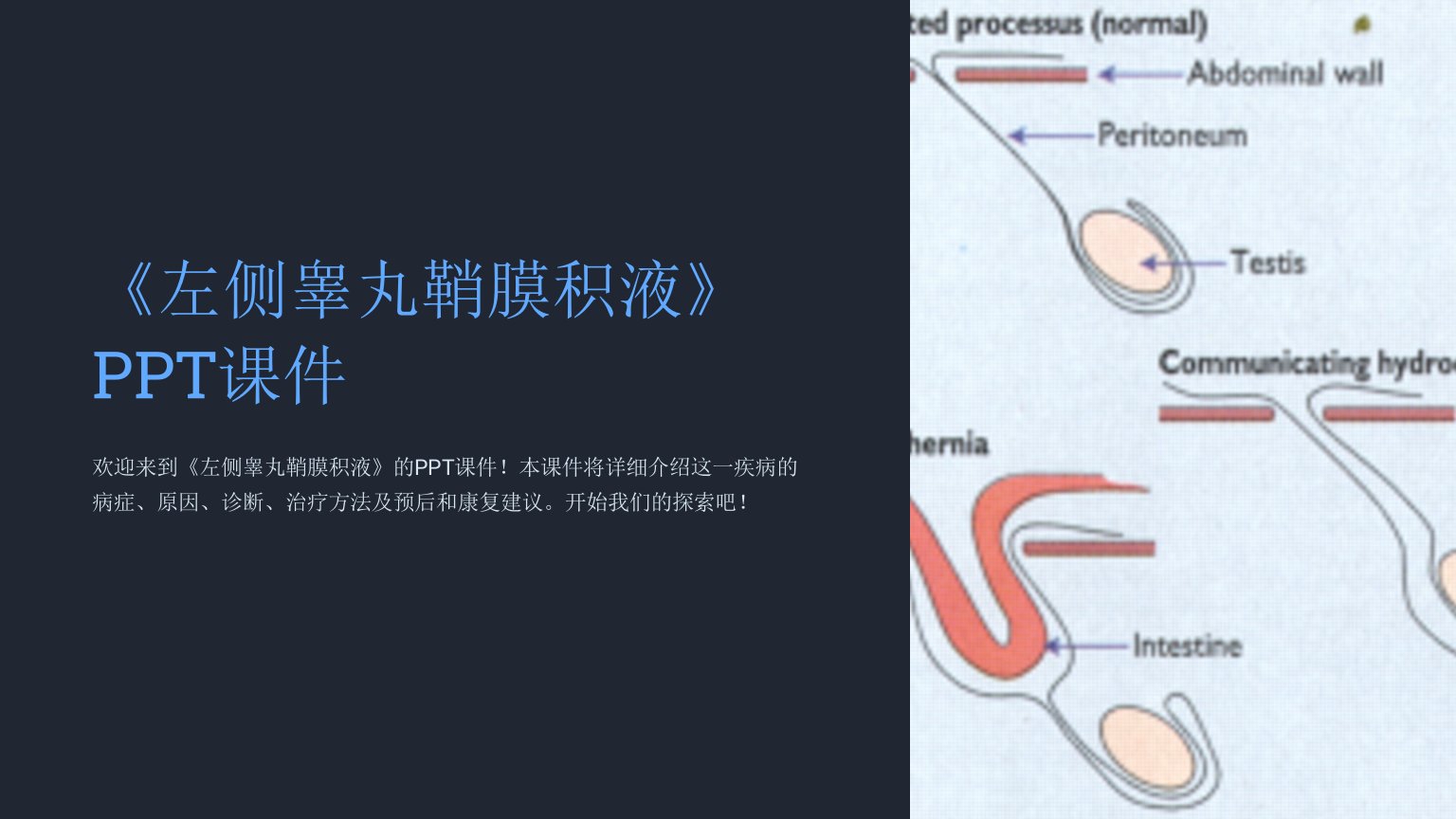 《左侧睾丸鞘膜积液》课件