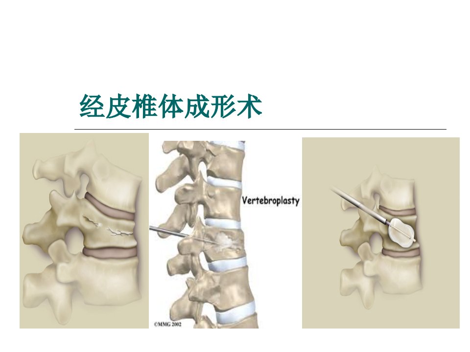 经皮椎体成形术