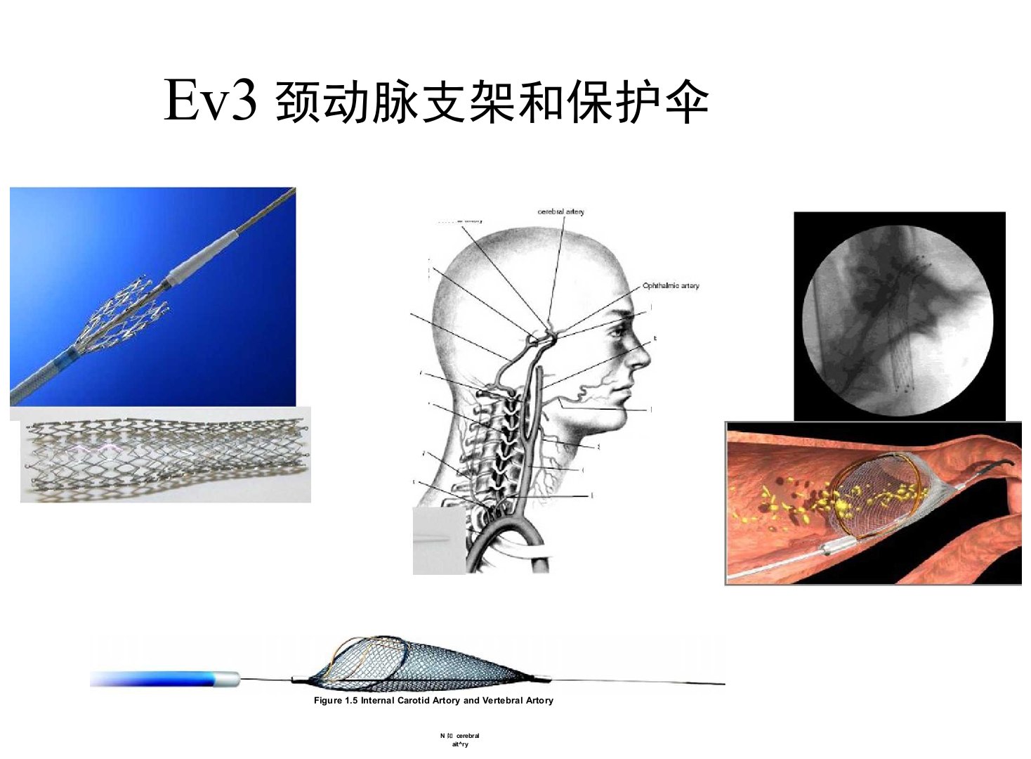 Ev3颈动脉支架和保护伞