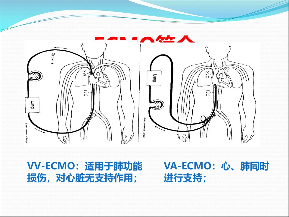 ECMO治疗中的感染课件