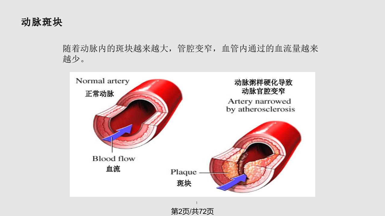 雅培心脏标志物