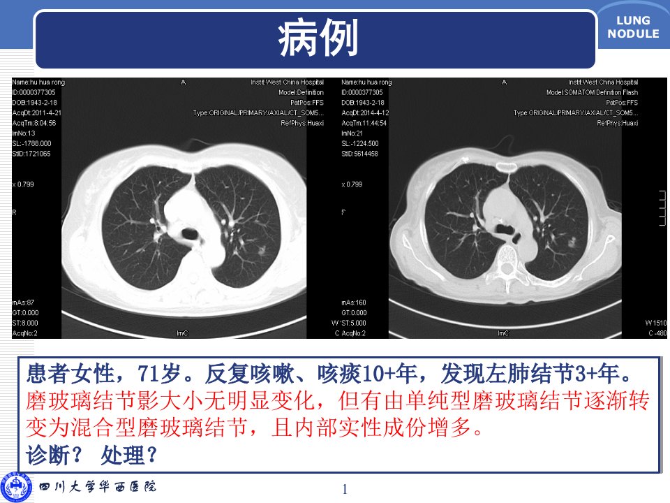 肺磨玻璃结节诊断与临床处理策略ppt课件