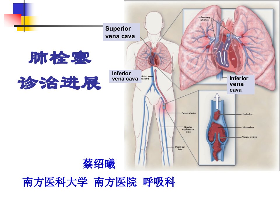 肺栓塞诊治进展