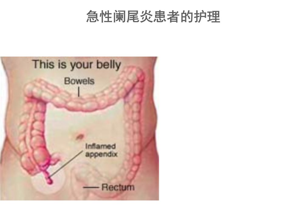 急性阑尾炎患者的护理PPT课件