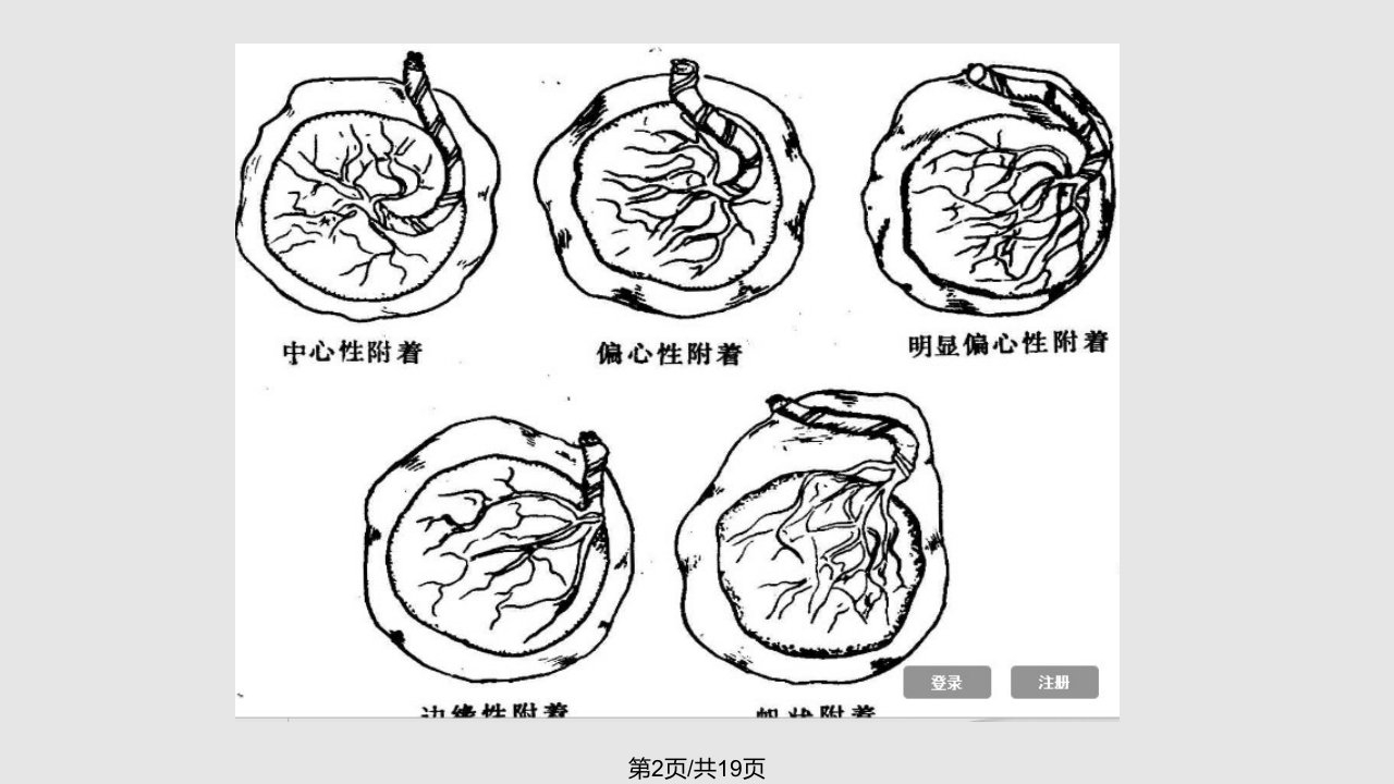 胎盘插入异常