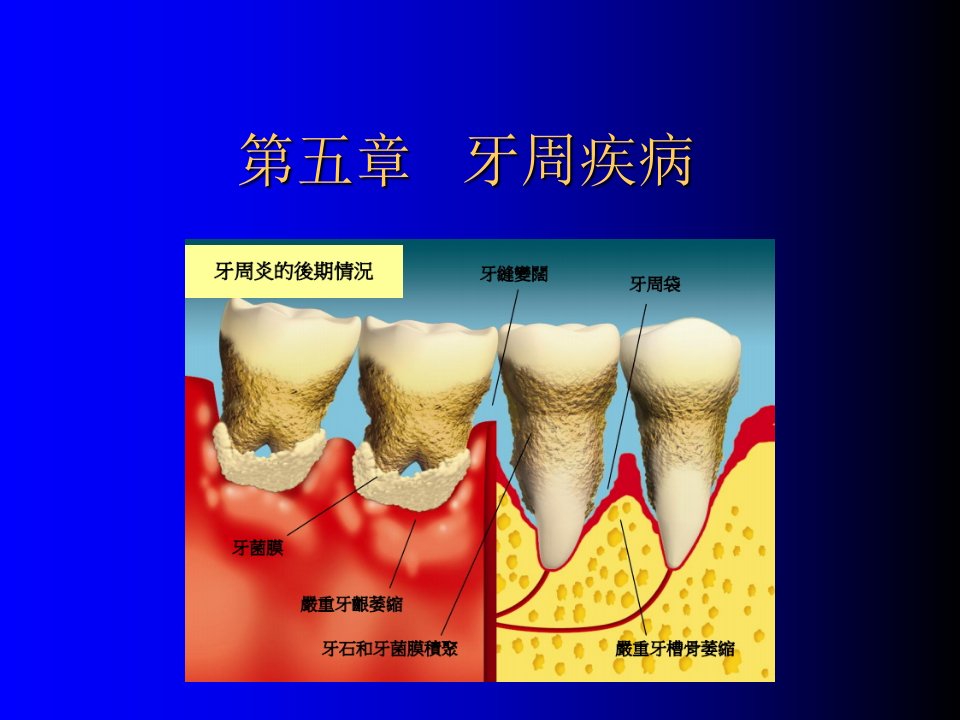 牙周组织疾病幻灯片