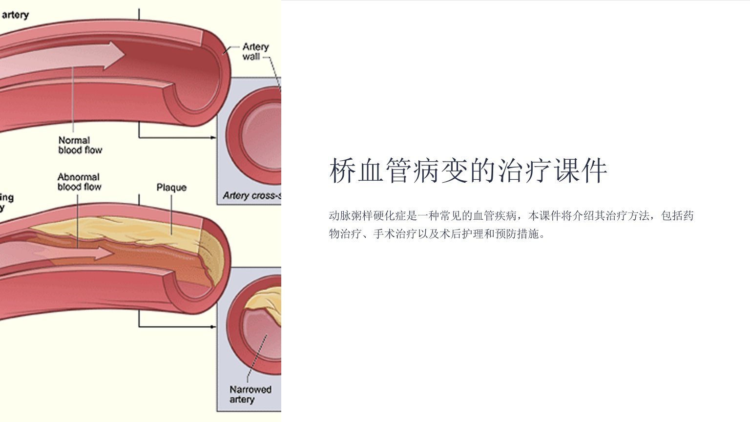 桥血管病变的治疗课件