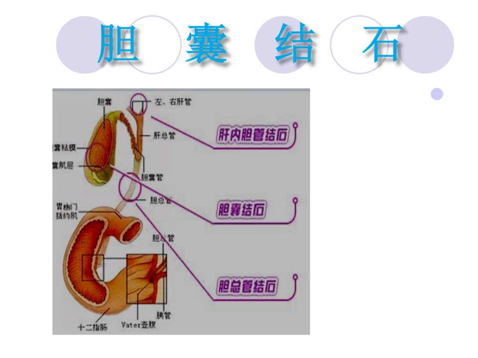 胆囊结石护理PPT