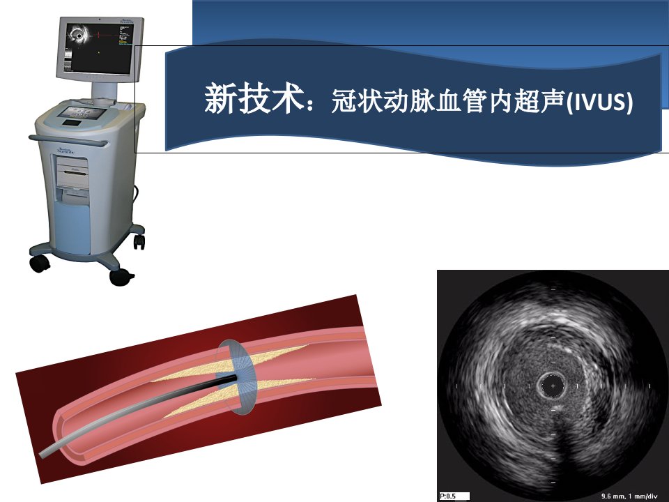 血管内超声IVUS简介