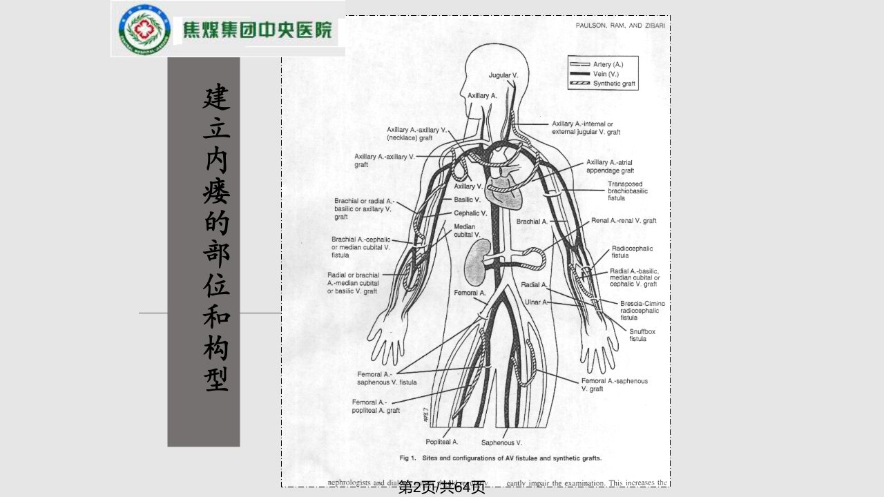 李正威内瘘血管评估使用和维护