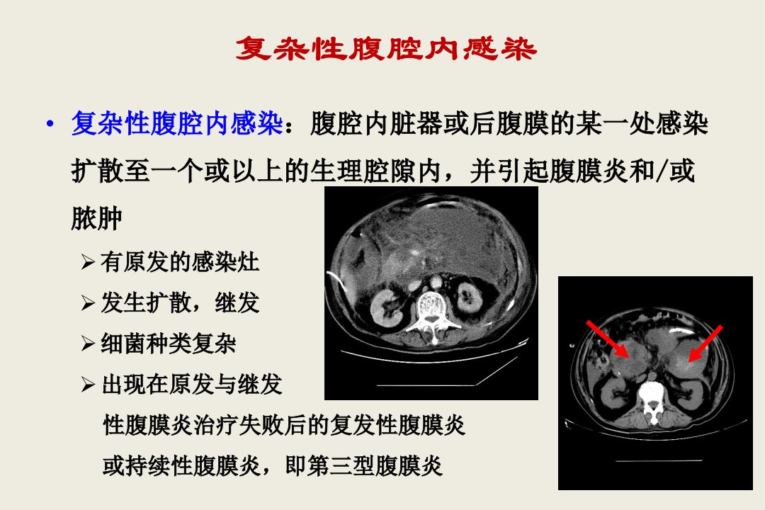 4.复杂性腹腔感染的处理毛恩强