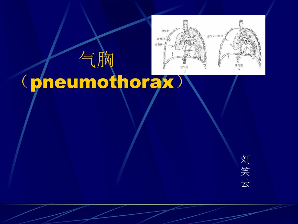 《气胸幻灯医学》PPT课件