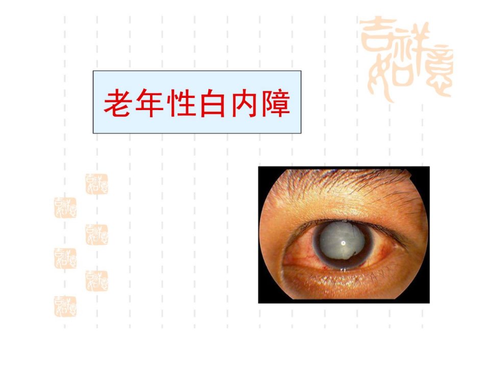 《老年性白内障》PPT课件