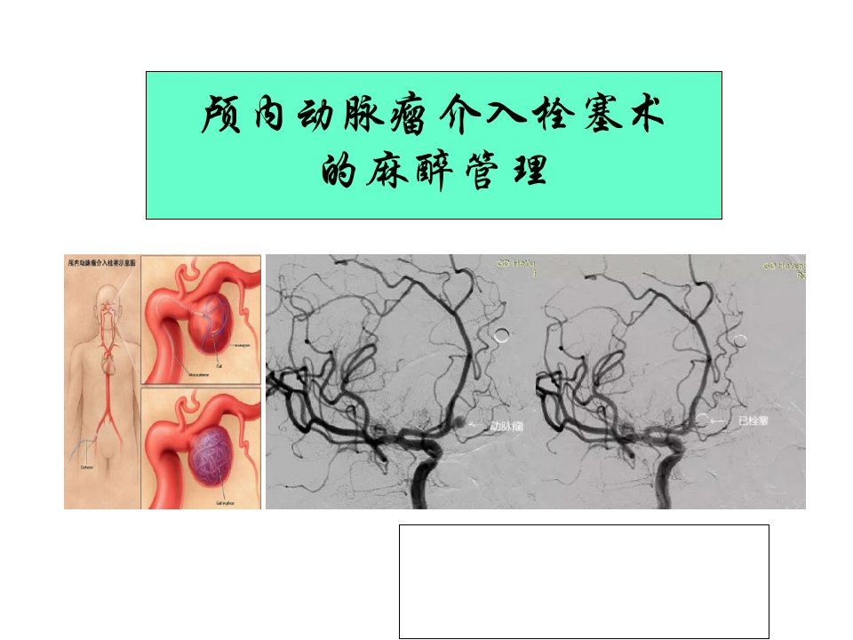 颅内动脉瘤介入栓塞术的麻醉管理