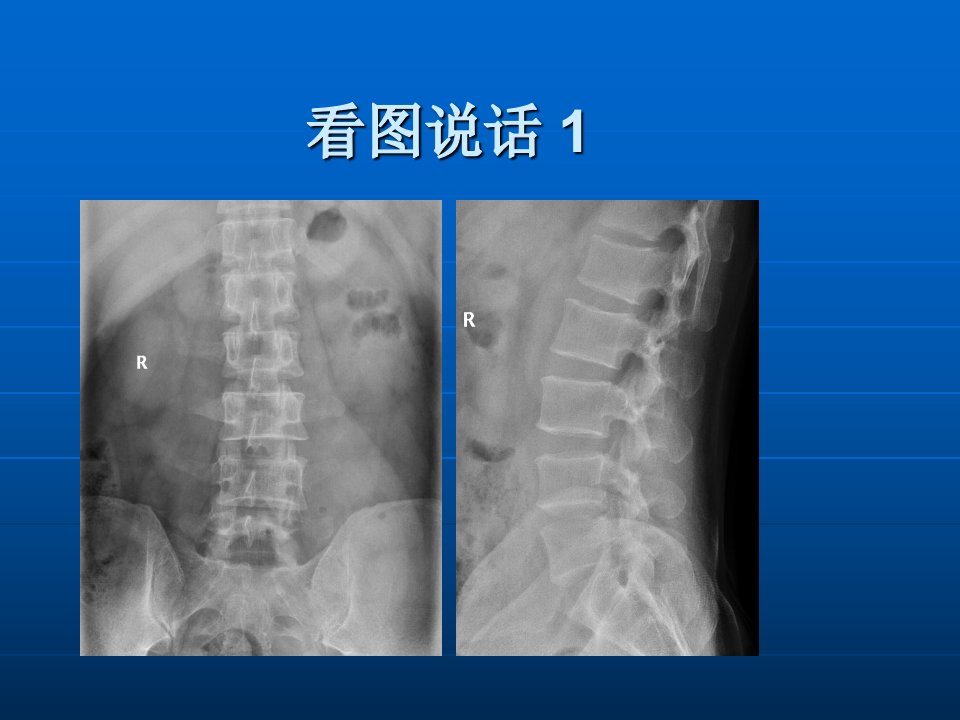 《椎体疾病随访》ppt课件