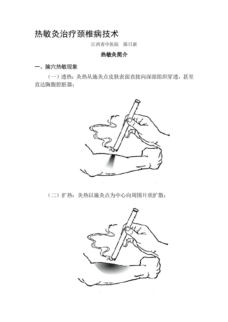 热敏灸治疗颈椎病技术===陈日新