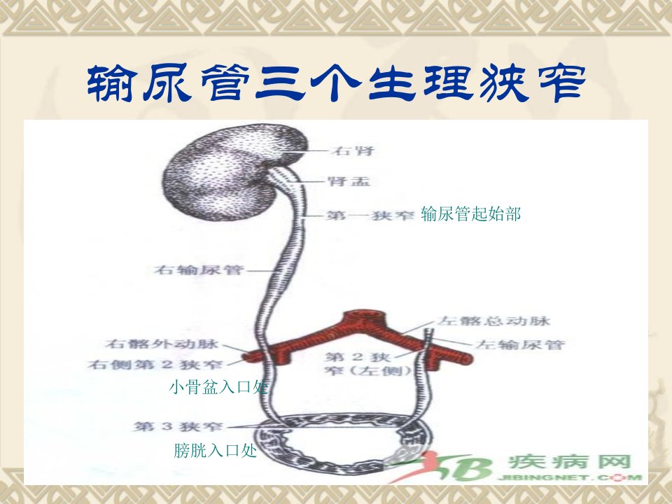 输尿管结石病人的护理业务学习