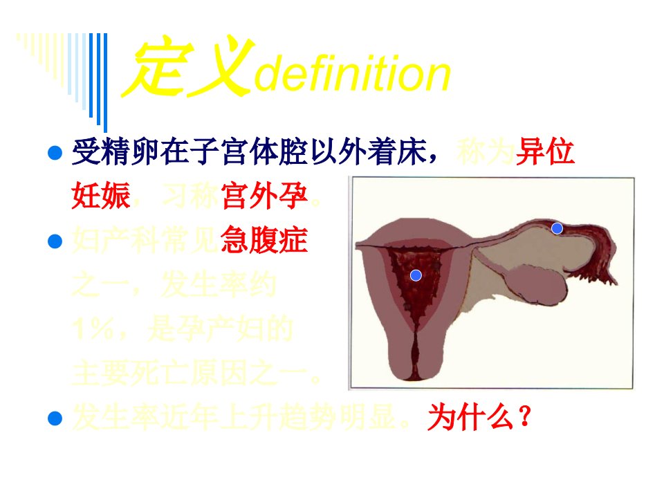 异位妊娠材料页课件