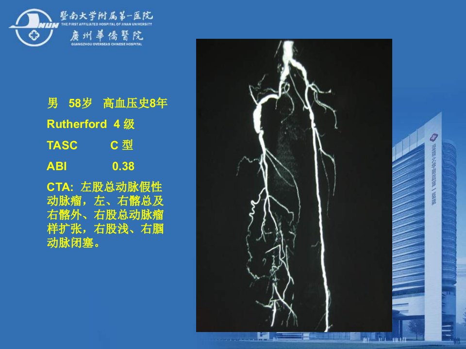 最新复合技术治疗下肢动脉闭塞应用暨南大学附属一医院精品课件