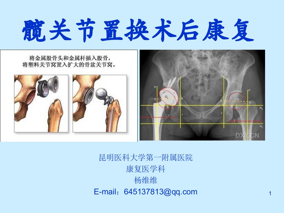 医学课件-髋关节置换术后康复-ppt课件