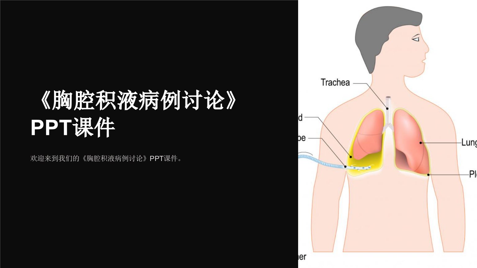 《胸腔积液病例讨论》课件