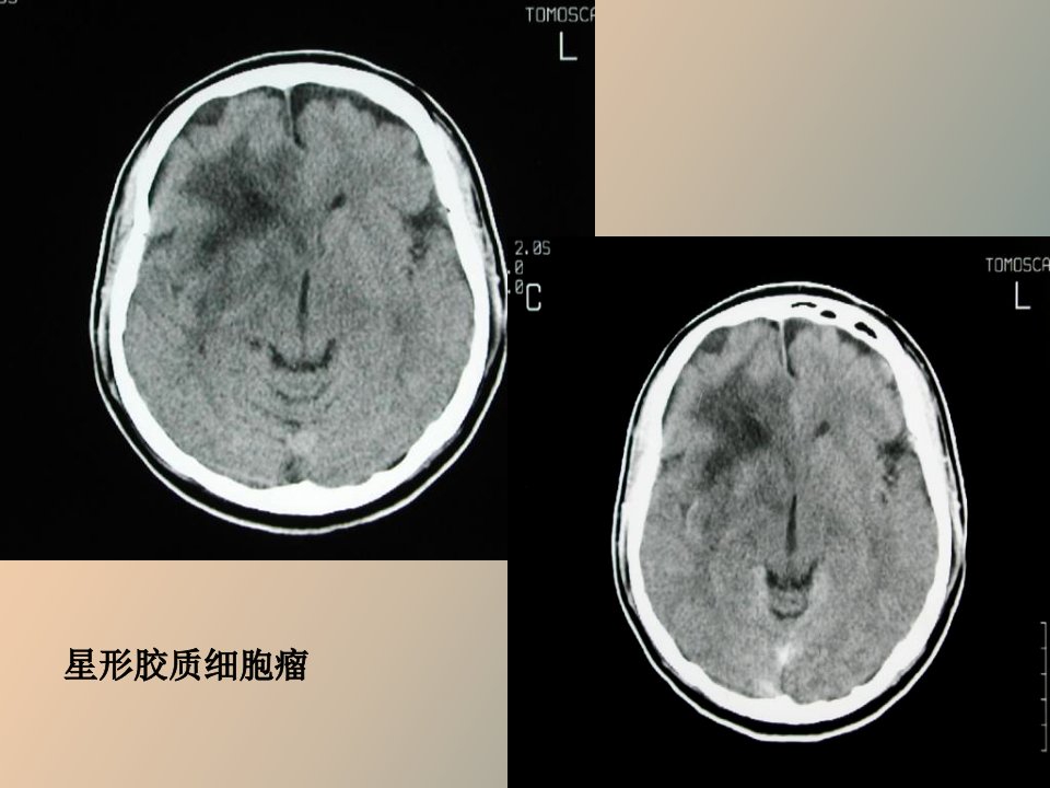 脑部疾病诊断